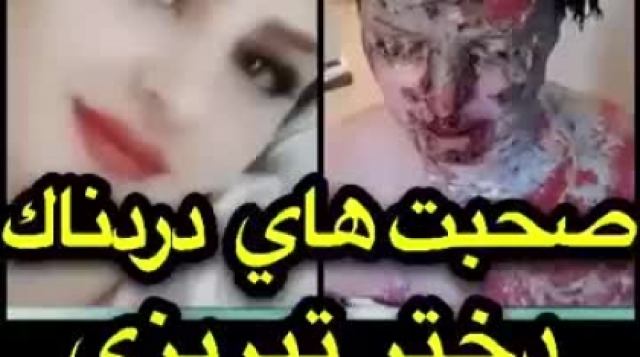 صحبت های دردناک دختر تبریزی قربانی اسید پاشی