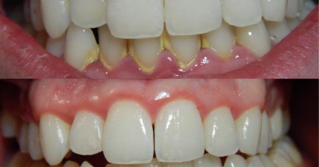 آیا جرمگیری دندان را لق می کند؟
