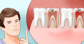 دلایل پوسیدگی دندان چیست؟ پوسیدگی ژنتیکی دندان چیست؟