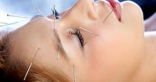 هر آنچه درباره ی طب سوزنی باید بدانید