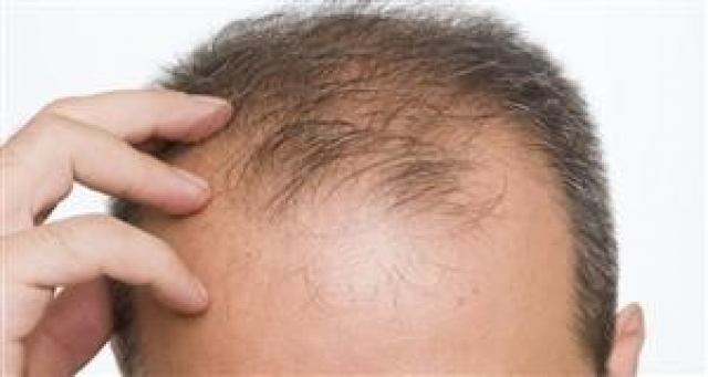 کدام روش‌ها برای درمان ریزش‌ مو مؤثرند؟