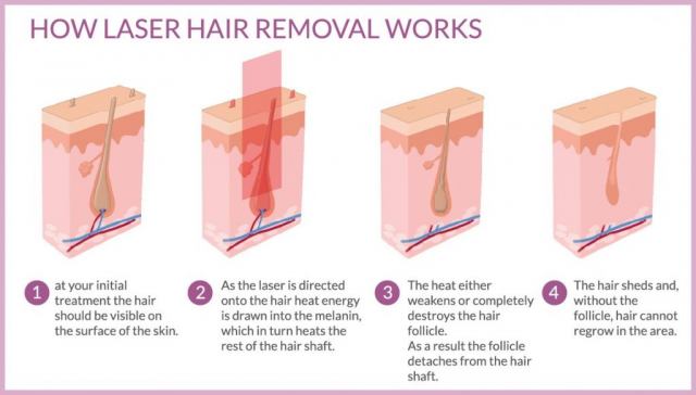 عوارض جانبی استفاده از لیزر برای موهای زائد چیست؟ - مقالات سلامتی