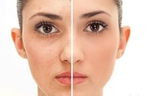 درمان لکه های قهوه ای پوست با ضد لک قوی خانگی