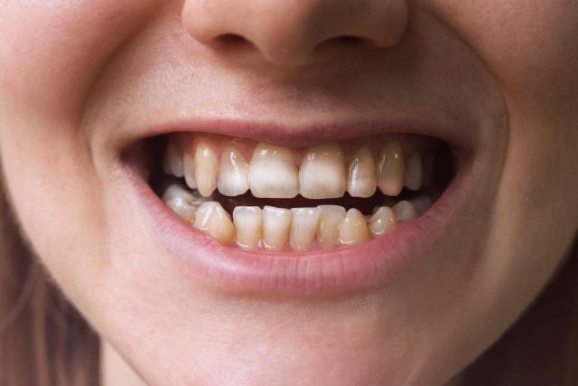 ارتباط لکه‌های روی دندان با بیماری سلیاک