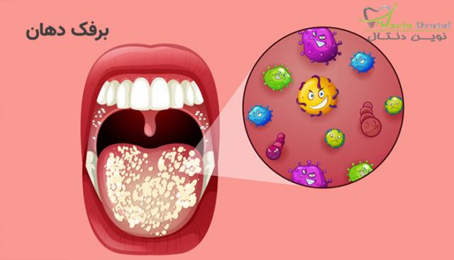 دلایل بیماری برفک در دهان چیست؟