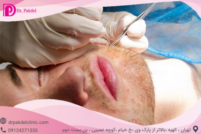 کاشت ریش چگونه انجام می شود؟ فیلم,قیمت,عوارض