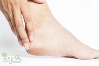 10 روش ساده و موثر برای درمان ترک پا