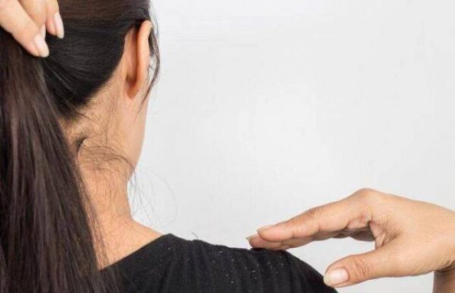 17 روش موثر برای رفع شوره سر در طب سنتی