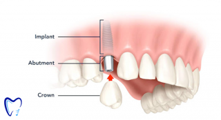 ایمپلنت دندان چیست؟ قیمت ایمپلنت دندان در سال 1400
