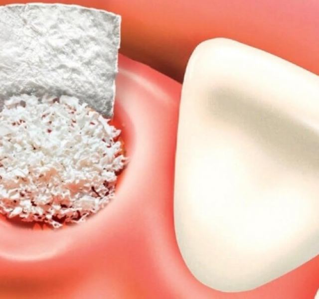 انواع پیوند استخوان در جراحی ایمپلنت دندان