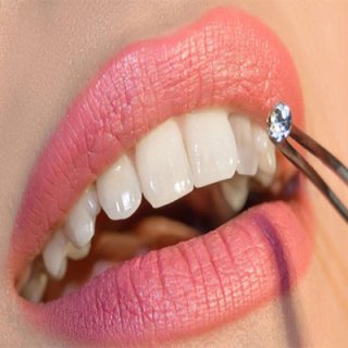 قیمت انواع روش های زیباسازی دندان
