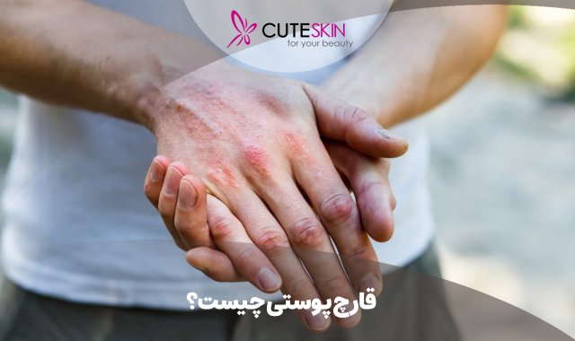 قارچ پوستی چیست؟ بررسی شایعترینها، علل و علائم!