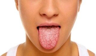 خشکی دهان / علل، علائم، عوارض و روشهای درمان خانگی