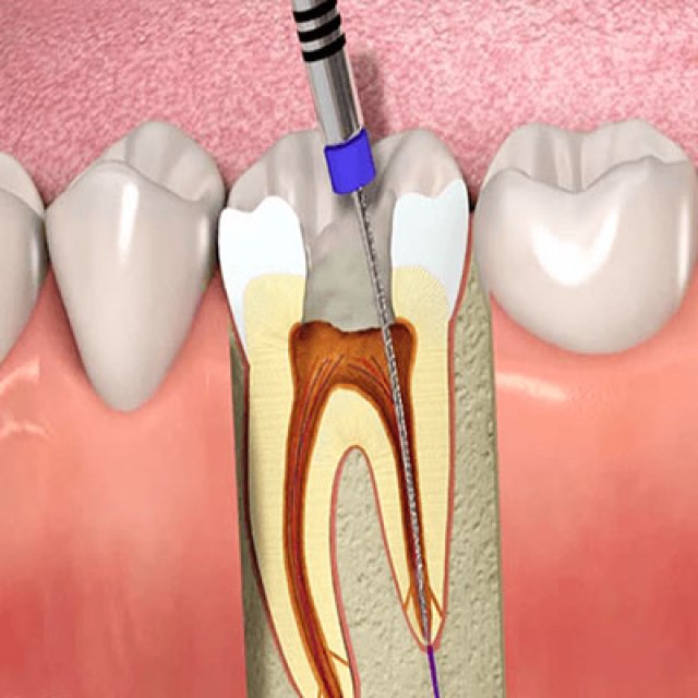 قیمت عصب کشی دندان در کرج+ علت درد بعد از عصب کشی