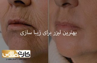 بهترین لیزر برای زیبا سازی در تهران کجاست؟