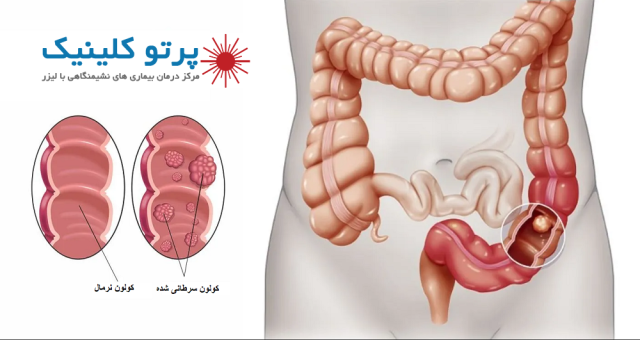 هشدار! مدفوع سیاه و خون آلود: ۲ زنگ خطر مهم برای سرطان