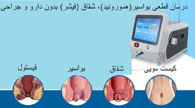 درمان قطعی بواسیر هموروئید شقاق فیشر بدون دارو و جراحی