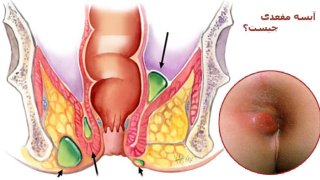 عوارض آبسه مقعدی چیست ؟