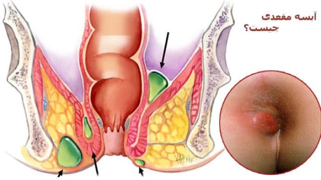 عوارض آبسه مقعدی چیست ؟