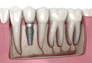 هر آنچه در مورد ایمپلنت دندان باید بدانید