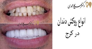 روکش دندان توسط دکتر مریم محمدی