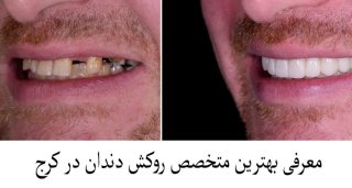 بهترین کلینیک دندانپزشکی در کرج برای روکش دندان