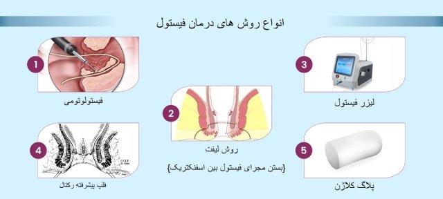 چگونه فیستول را بدون جراحی درمان کنیم