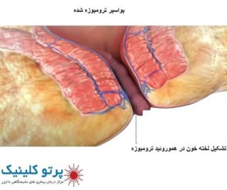 بواسیر خارجی خطرناک تر است یا داخلی؟