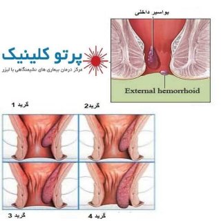 درمان بواسیر در خانه و هر آنچه که باید بدانید