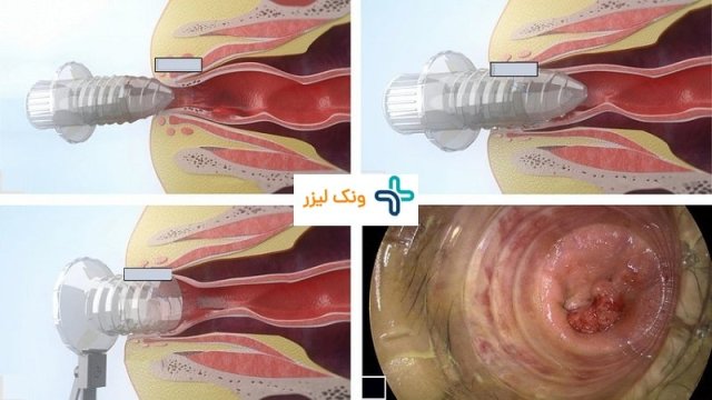 دیلاتاسیون فیشر (شقاق)