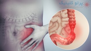 انواع سندروم روده تحریک پذیر