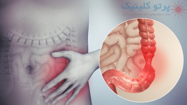 انواع سندروم روده تحریک پذیر