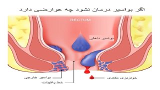 اگر بواسیر درمان نشود چه میشود[+10 عوارض عدم درمان هموروئید]