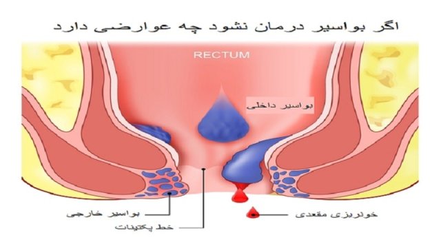 اگر بواسیر درمان نشود چه میشود[+10 عوارض عدم درمان هموروئید]