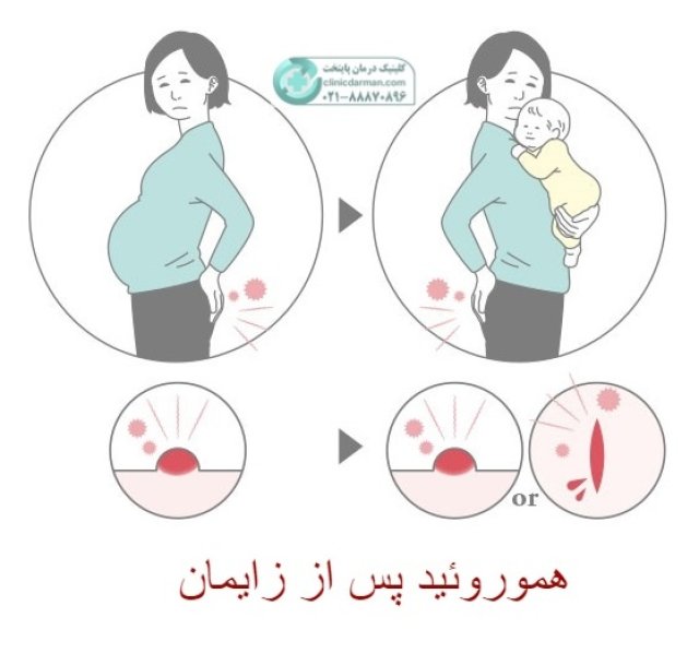 درمان خانگی بواسیر بعد از زایمان طبیعی [معرفی ۵ روش فوری]
