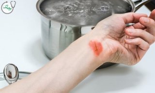 چگونه سوختن با آب جوش را در خانه درمان کنیم؟