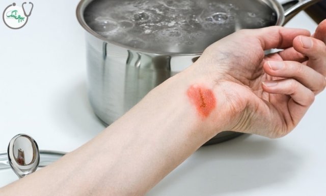چگونه سوختن با آب جوش را در خانه درمان کنیم؟