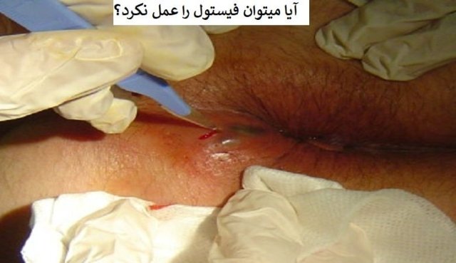 چگونه فیستول را بدون عمل درمان کردن درمان کنیم؟