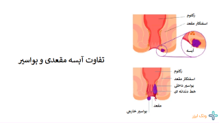 از کجا بفهمیم بواسیر داریم یا آبسه؟