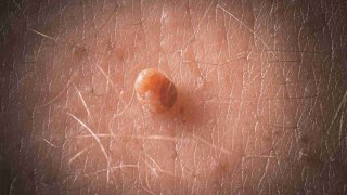 راهنمای انتخاب پزشک مناسب برای درمان زگیل تناسلی