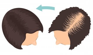 کاشت مو در قزوین با روش‌های مدرن و اقساطی