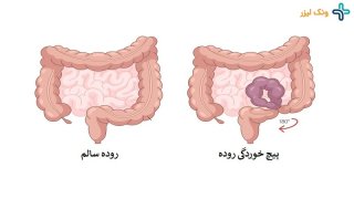 علت پیچ خوردگی روده چیست و چگونه میتوان آن را درمان کرد؟