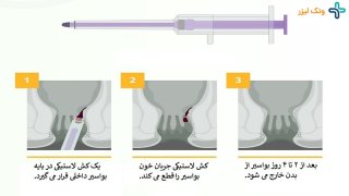 درمان بواسیر با استفاده از رابربند 