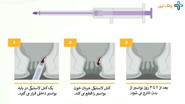 درمان بواسیر با استفاده از رابربند 