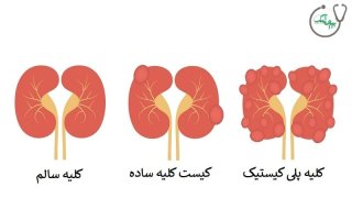 کیست کلیه چگونه درمان می شود؟