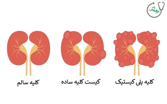 کیست کلیه چگونه درمان می شود؟