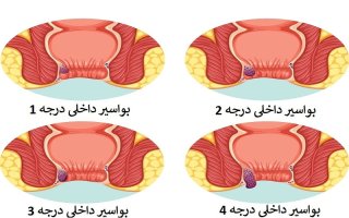 انواع بواسیر {داخلی و خارجی}