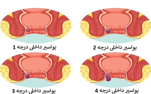 انواع بواسیر {داخلی و خارجی}