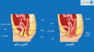 همه چیز در مورد بیماری رکتوسل و روشهای درمان آن