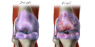 علائم مهم برای درمان آرتروز زانو